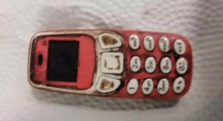 Əməliyyat olunan şəxsin mədəsindən "Nokia" çıxdı - FOTO