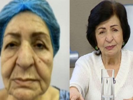 "Plastik əməliyyatla 15 yaş cavanlaşdım" - Kübra Əliyeva
