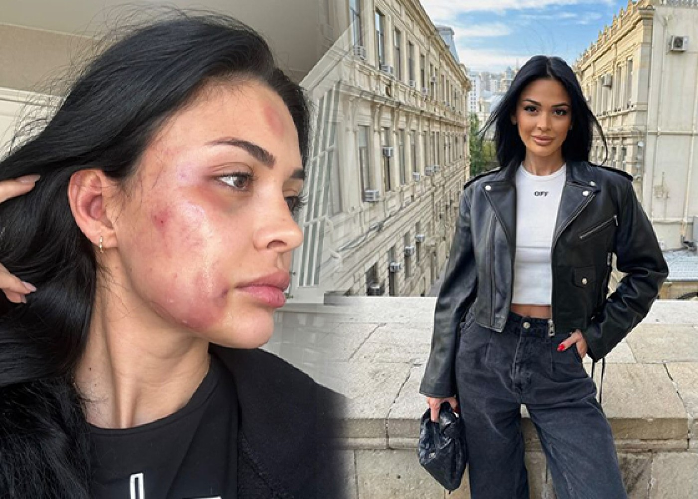Azərbaycanlı model sevgilisi tərəfindən döyüldü