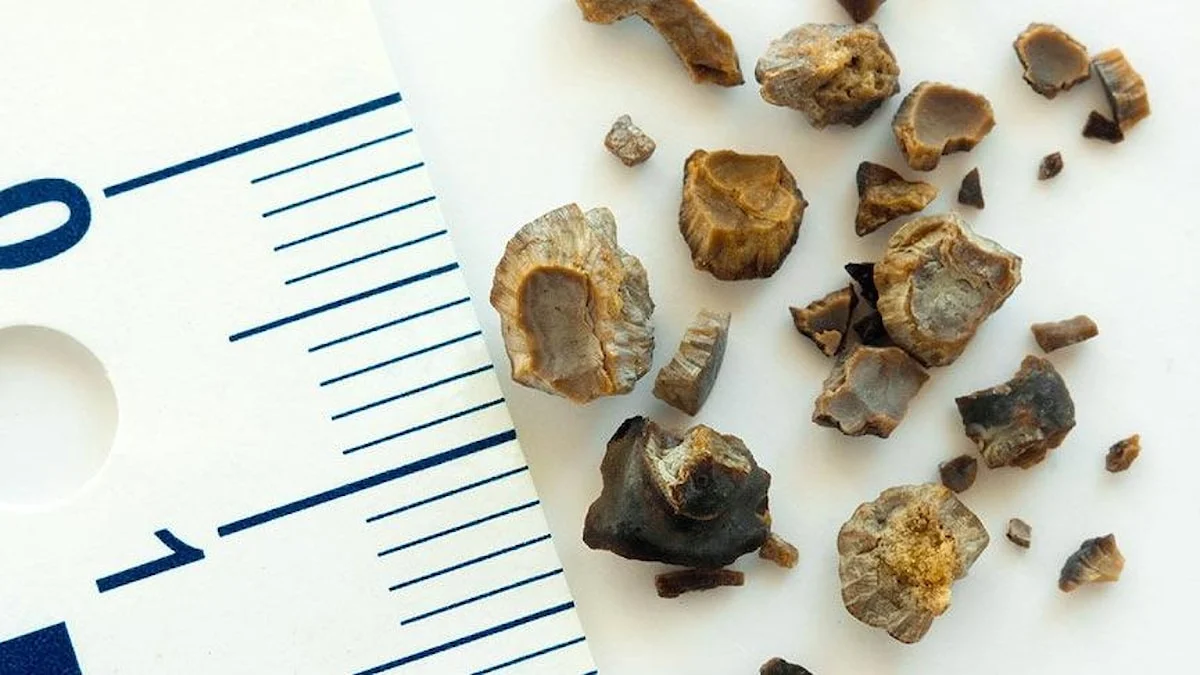 Dünyanın ən böyük böyrək daşı çıxarıldı: 801 qram