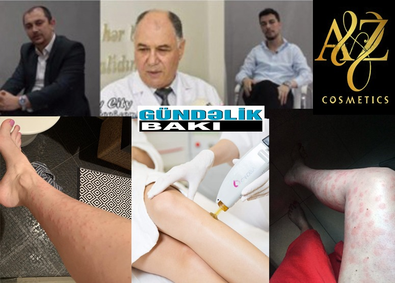 Kənan Zeynalovun AZCOSMETİCS.MMC şirkətinin Çindən gətirdiyi lazer avadanlıqlar qadınlara problem yaradır… - Avropada 200-250 min dəyərində olan və Çindən gətirilən 15-20 minlik lazer avadanlığı eyni effekti verə bilməz…