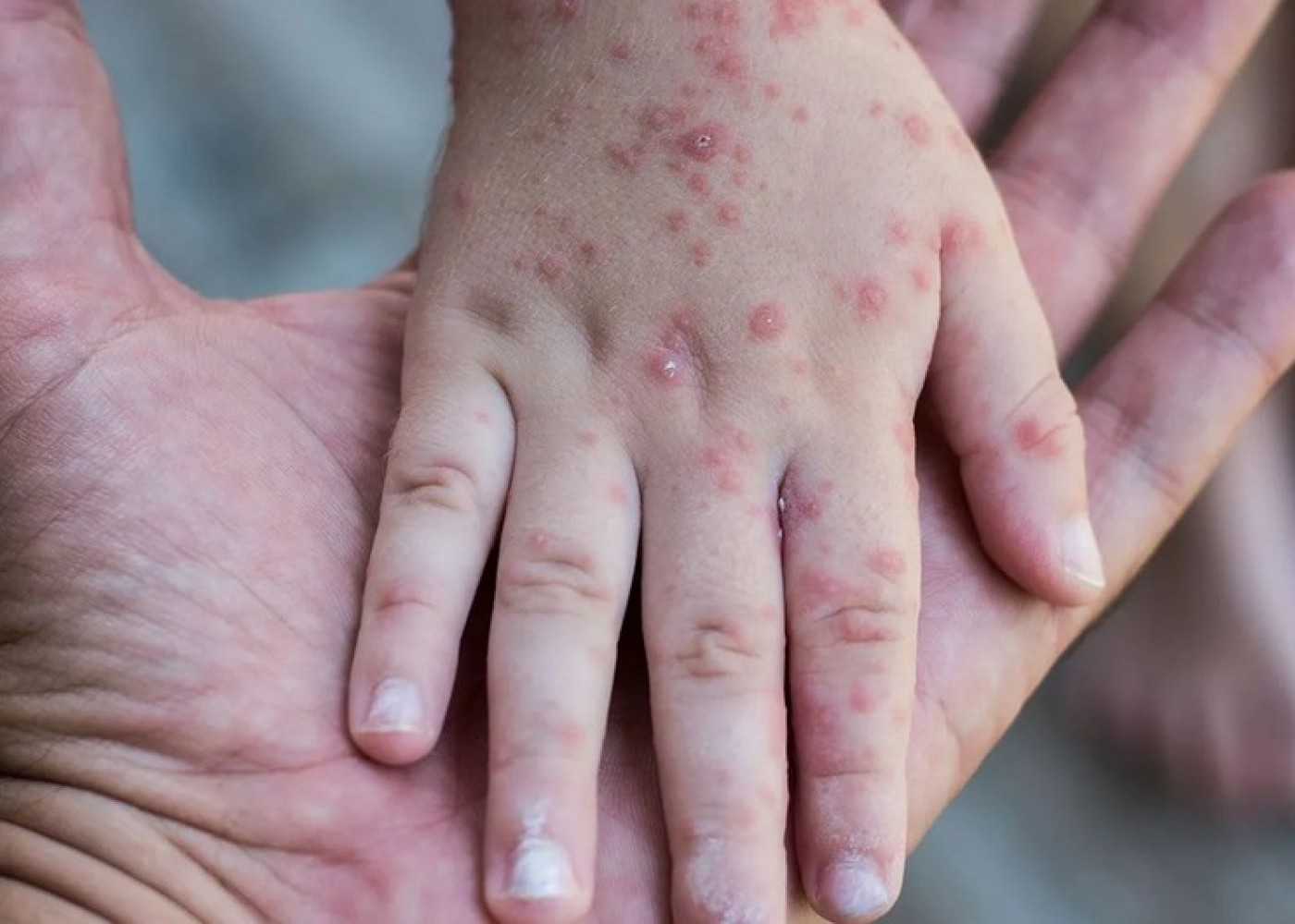 Qızılcaya yoluxanlara antibiotik vurmaq olmaz - RƏSMİ