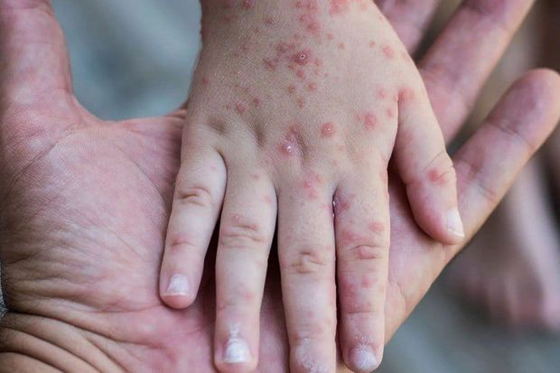 Əvvəlki illərdə qızılcadan ölüm sayı nə qədər olub? - STATİSTİKA