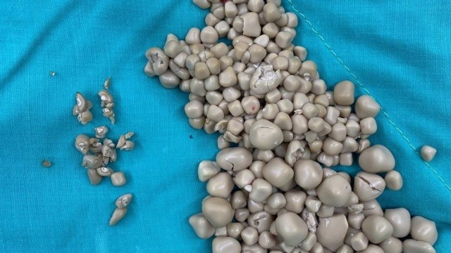 20 yaşlı qızın böyrəklərindən 300-dən çox daş çıxarıldı - FOTO